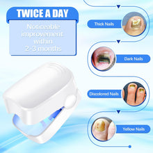 Rechargeable Nail Fungus Laser  Anti-Fungal Device Toenails, Hands & Feet (Home Use)